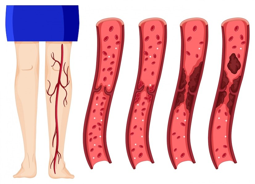 Best Varicose Veins Treatment in Safdarjung Enclave.