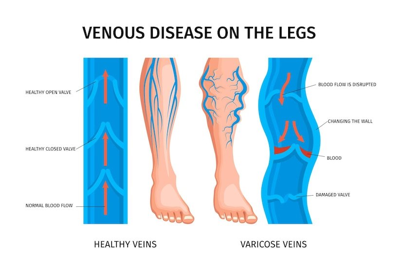 best varicose vein surgeon in Safdarjung Enclave