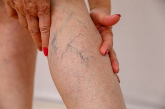 Best varicose vein treatment in Delhi