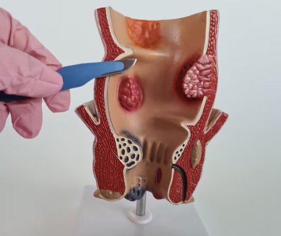 Best Piles Treatment in South Delhi