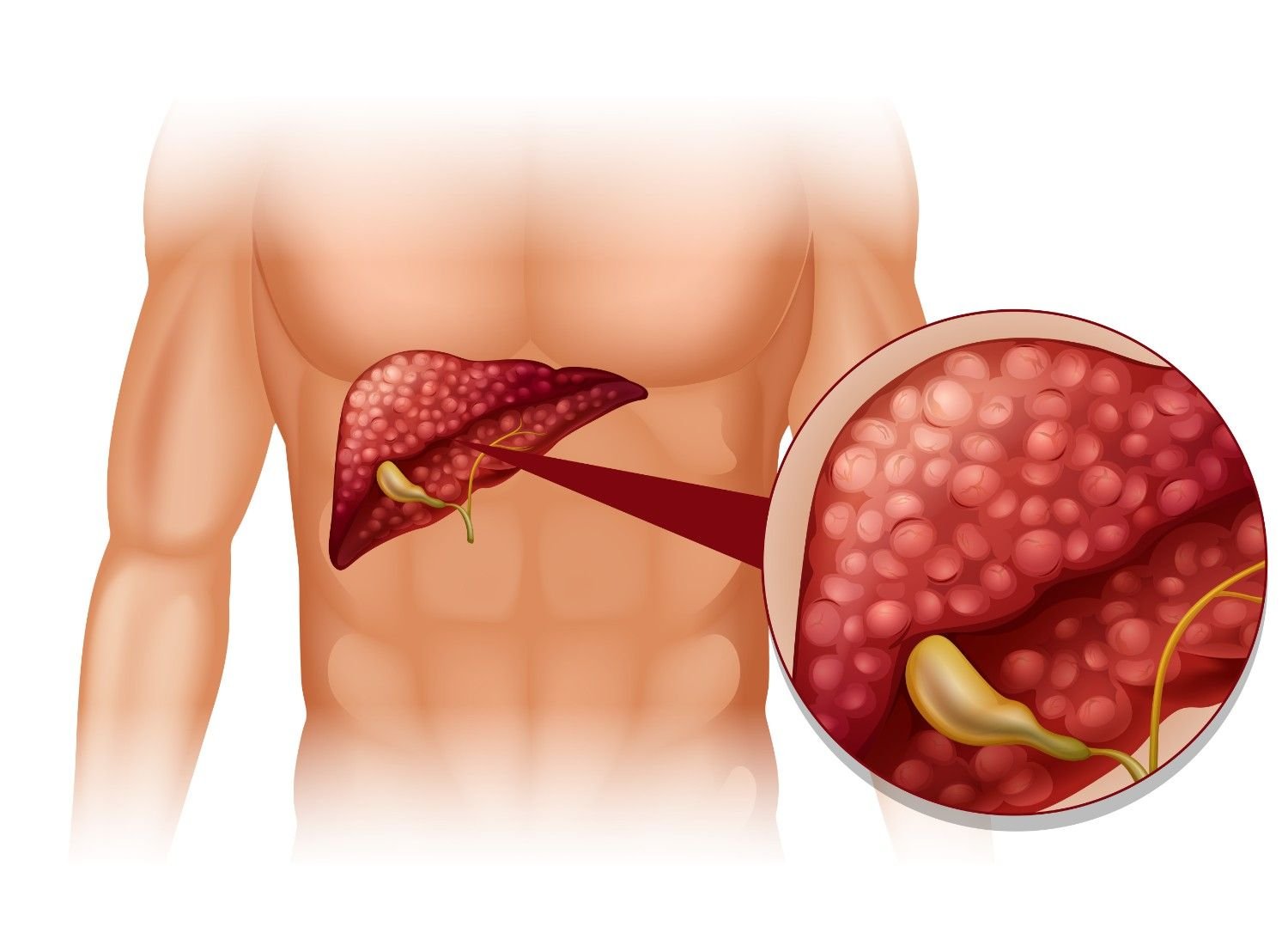 Best Gall Bladder Stone Hospital in New Delhi