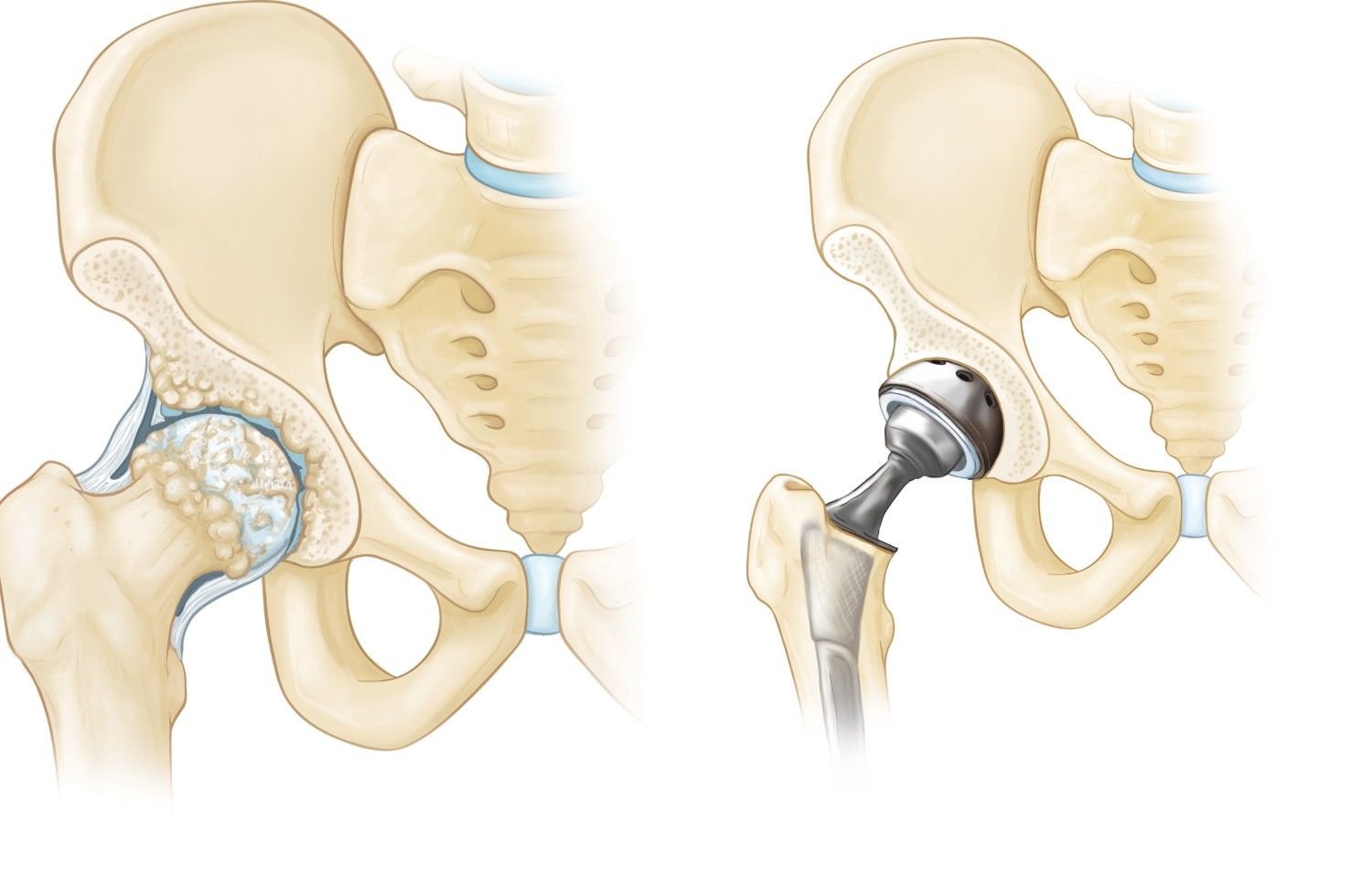Best Joint Replacement Treatment in South Delhi